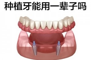 天津诺贝尔pmc种植牙可以用多久呢